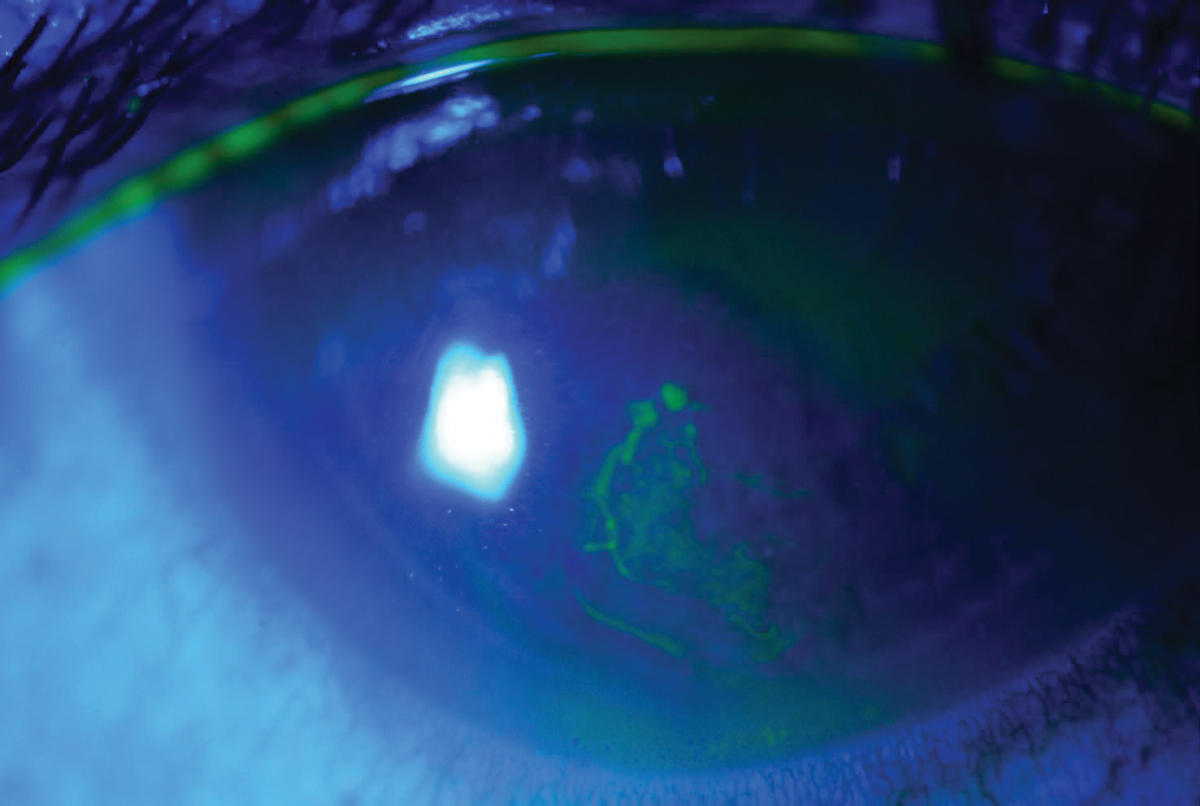 A patient with recurrent corneal erosion.