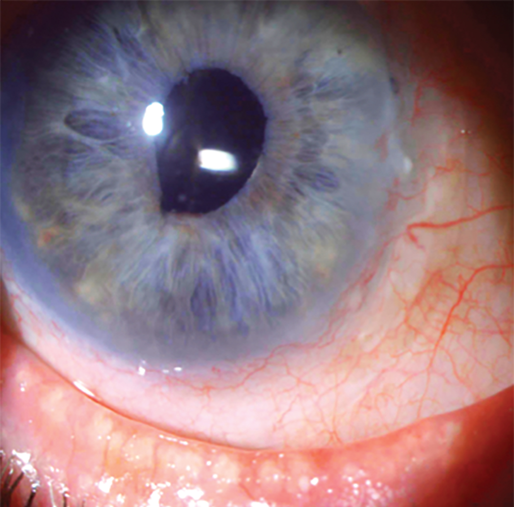 A patient with limbal stem cell deficiency. 