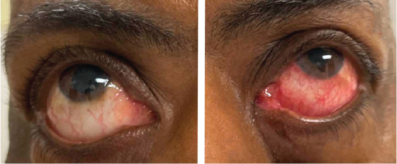 Note the asymmetry in conjunctival injection between the right and left eyes. Images were taken after the instillation of tropicamide and phenylephrine drops.