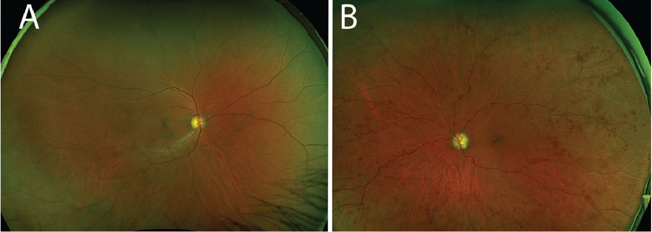 (A) The right fundus was largely unremarkable. (B) In the left fundus, one can appreciate the extensive blot hemorrhages in the midperiphery and periphery. Note the attenuated arteries and dilated veins.