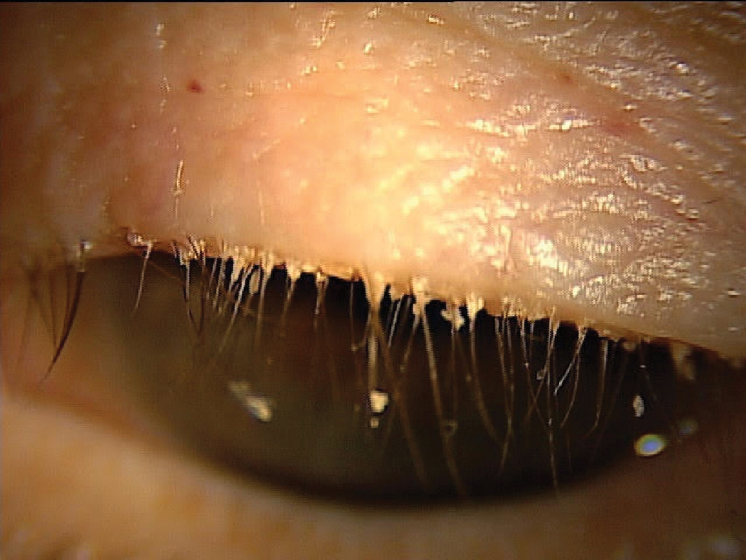 Having a patient look slightly down identifies collarettes in Demodex blepharitis.
