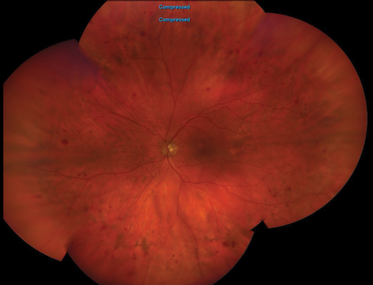 Fig. 1. Here is a widefield view of the left eye of our patient. Note the peripheral retinal hemorrhages. What is the etiology?