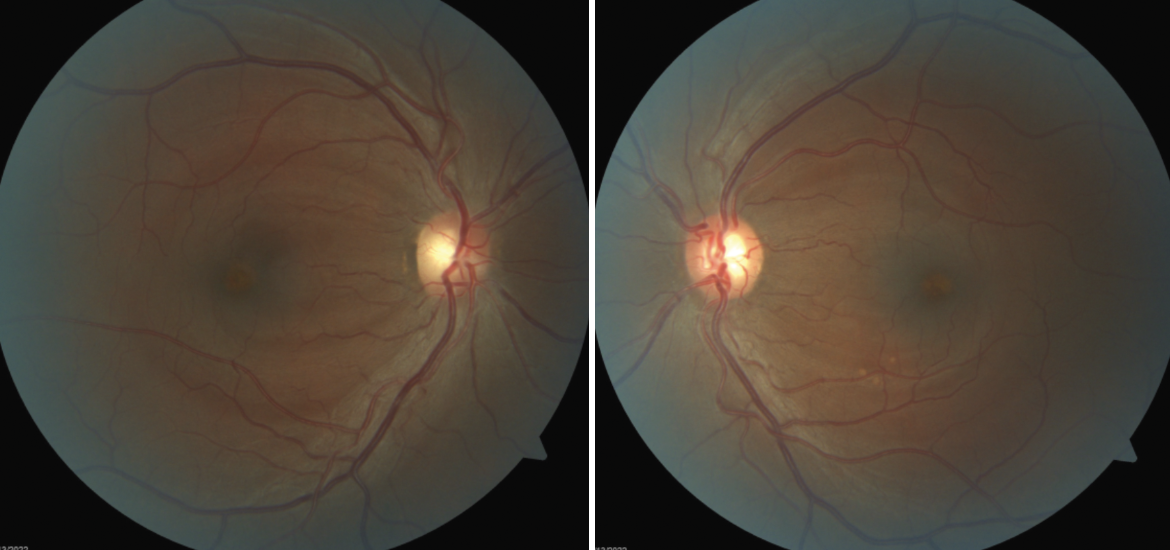 Bilateral macular lesions can arise from myriad conditions that an OD must rule out.