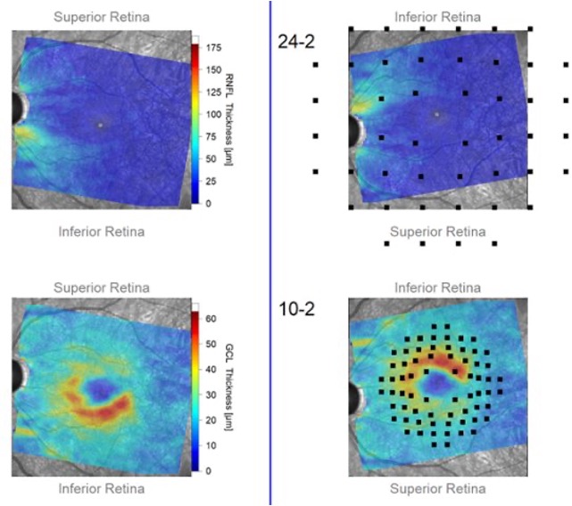 Images show macular structural data with superimposed visual field loci taken from a portion of a Hood Report, which is one tool that can aid in glaucoma diagnosis.