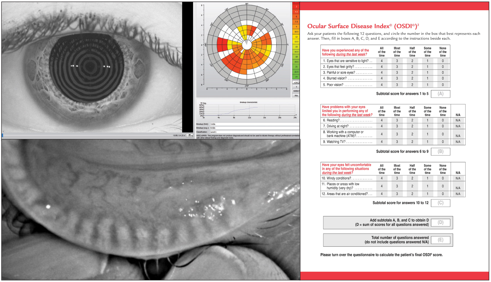 Noninvasive breakup time, meibomian gland shortening and performance on the OSDI questionnaire could give you early indications of a dry eye patient who’s about to become symptomatic.