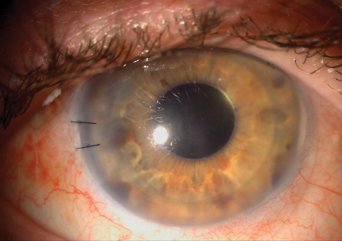 Keratoplasty may alter certain ocular surface parameters after the procedure.