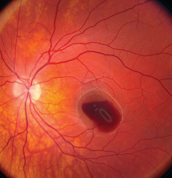 Vitrectomy or pneumatic displacement may result in better outcomes than anti-VEGF therapy for those with submacular hemorrhage.