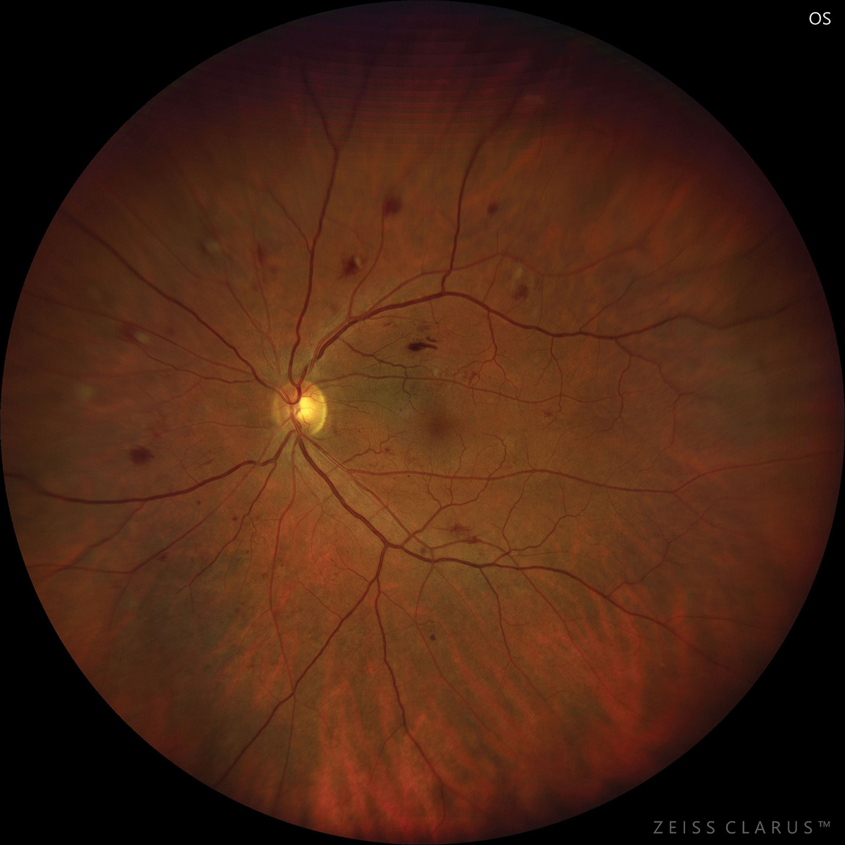 Diabetes patients may experience faster progression of retinal neurodegeneration and choroidal thinning. 