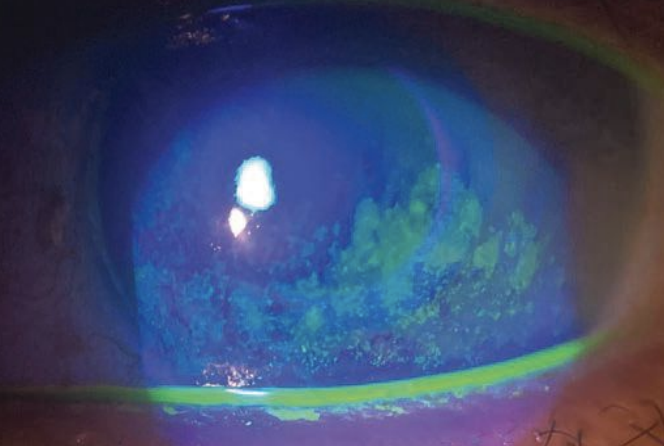 Here is another patient with severe keratoconjunctivitis sicca, this one with active fluorescein staining.