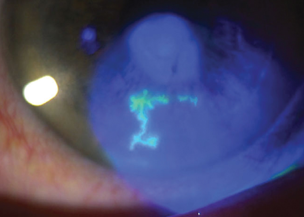 Antivirals are effective in treating several ocular infections such as herpes simplex keratitis. Allowing optometrists to prescribe these meds at the first sign of infection increases the likelihood of a positive outcome.