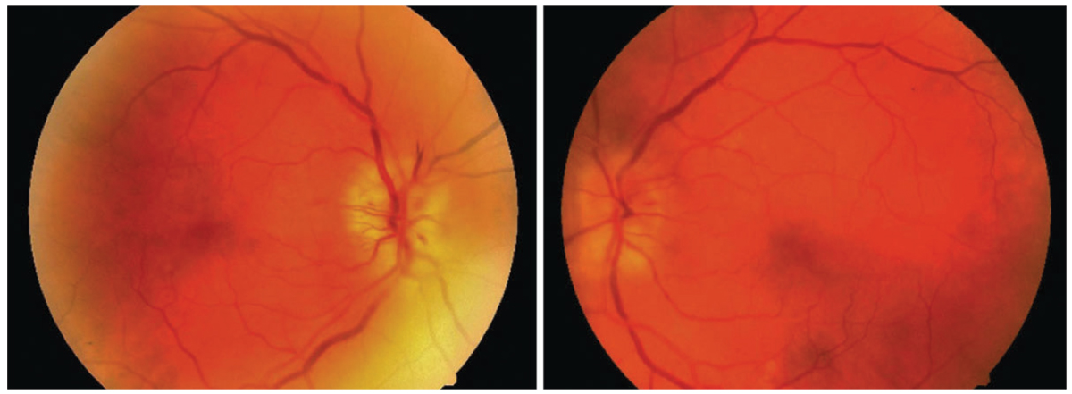 This patient’s anterior ischemic optic neuropathy was effectively resolved with a systemic steroid; however, the patient had diabetes, which worsened secondary to steroid treatment. It’s important to be aware of this contraindication for those with this comorbidity.