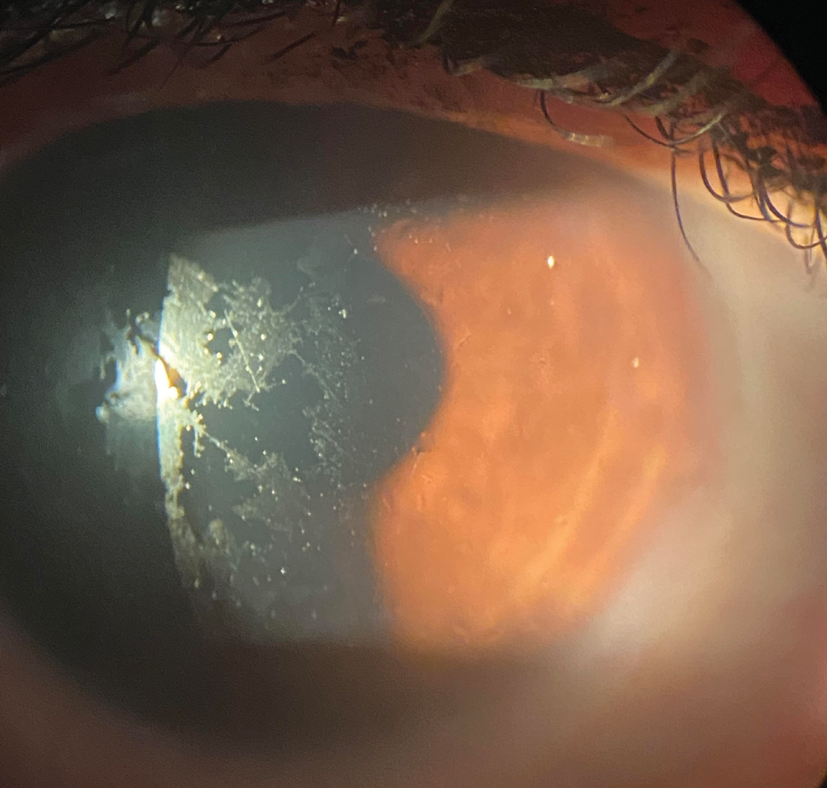 A patient complaining of discomfort and foggy vision, showing poor wettability of their scleral lens. The issues resolved with the addition of a Hydra-PEG coating.
