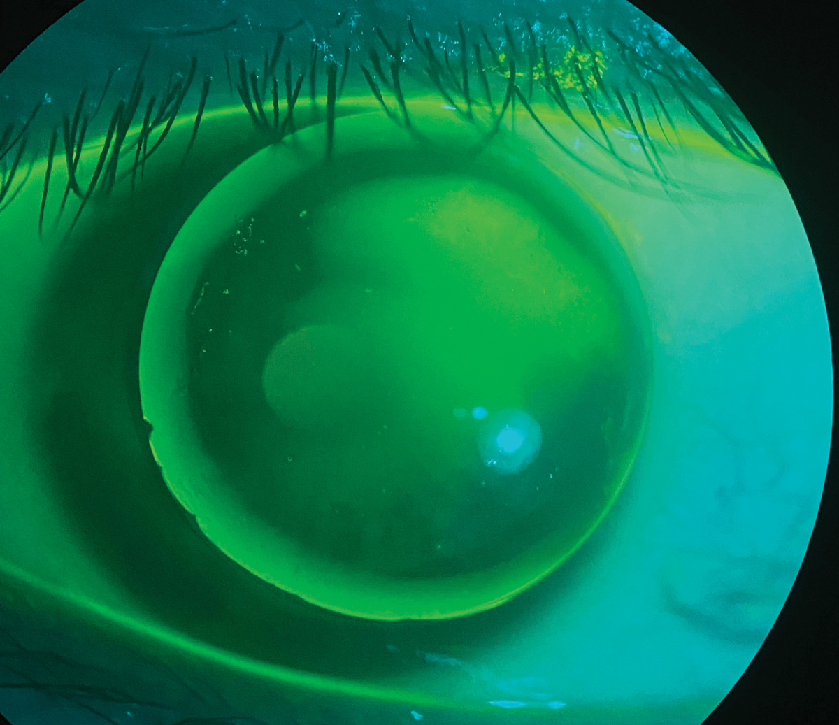A patient wearing a GP lens presenting with issues of severe discomfort and peripheral corneal staining from a chipped edge.