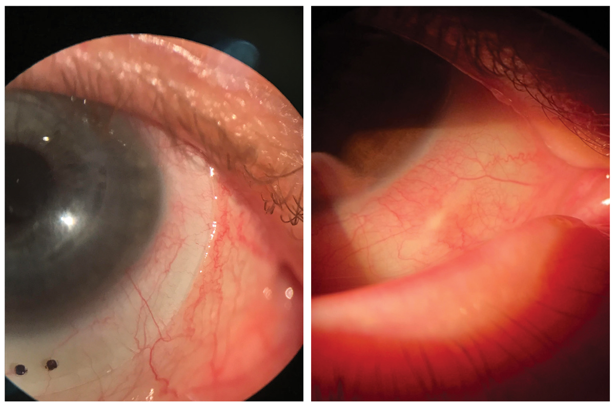 At left, scleral blanching and impingement causing discomfort stemming from scleral misalignment. At right, long-standing impingement can lead to conjunctival hypertrophy and other permanent changes to the tissue, so it’s important that misalignment is addressed during the fitting process.
