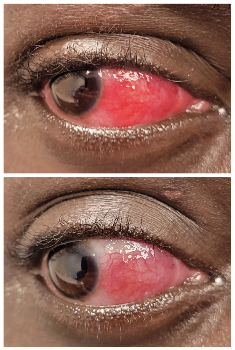 Most cases of scleritis will only blanch partially with topical 2.5% phenylephrine.