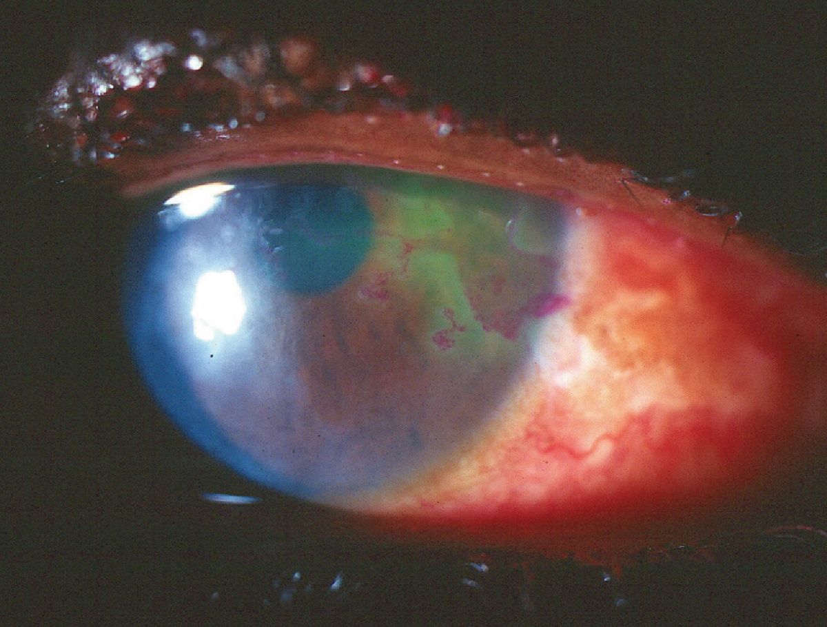 Neurotrophic corneal ulcer from herpes simplex.
