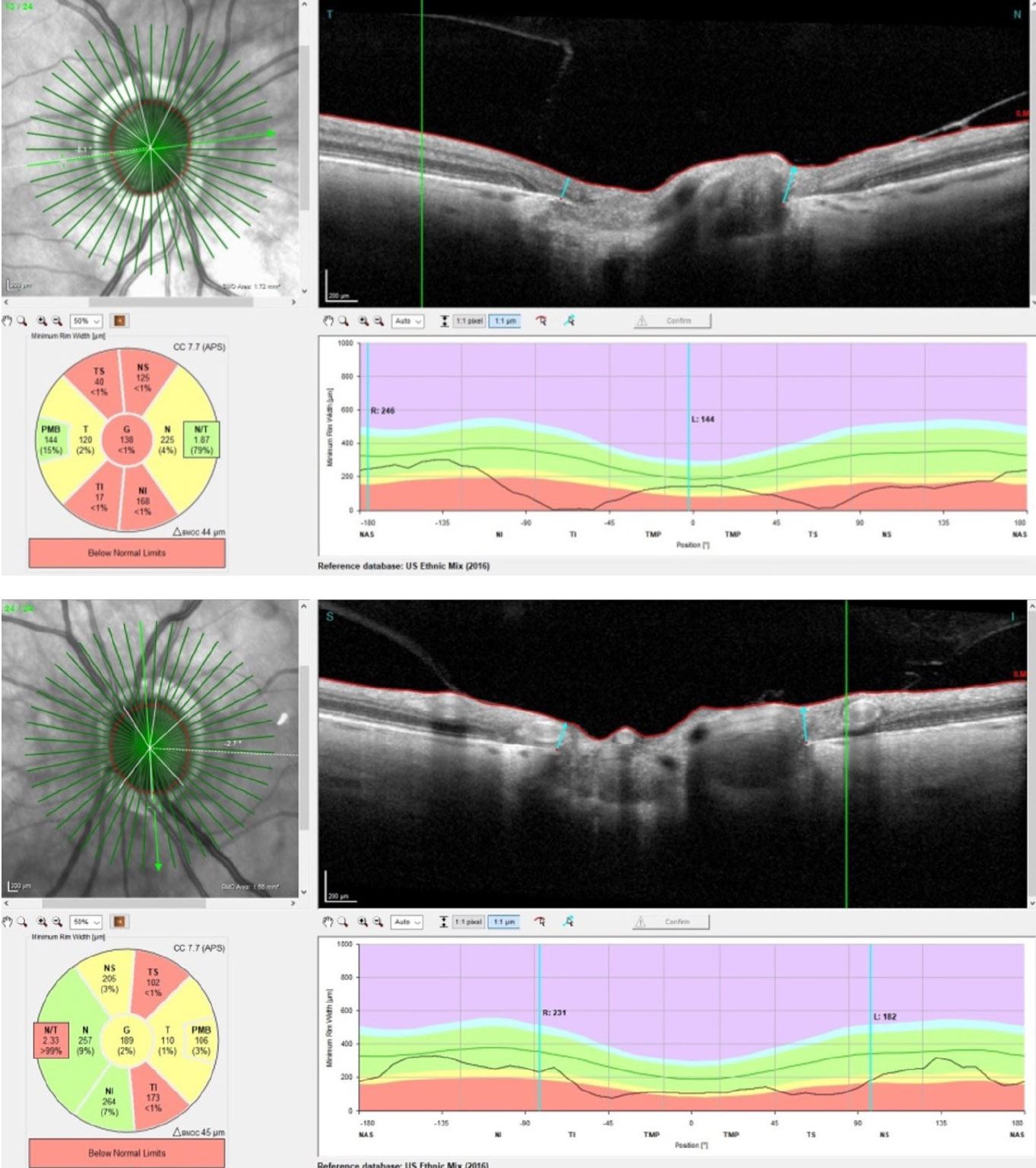 The radial BMO-MRW scans of the patient’s right (top) and left (bottom) eyes. Note the OCT segmentation of the PMB in each eye; interestingly, the right PMB is essentially normal, and the left is somewhat compromised.