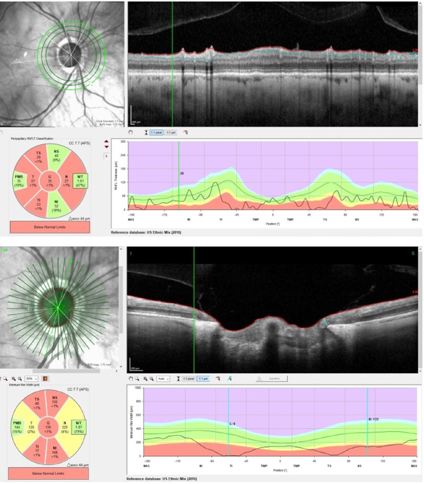Superior temporal and inferotemporal RNFL thinning OD, not inconsistent with glaucoma, with preservation of the PMB (top). An eroded inferotemporal neuroretinal rim with a paltry 6µm of tissue remaining at the scan marker (bottom).