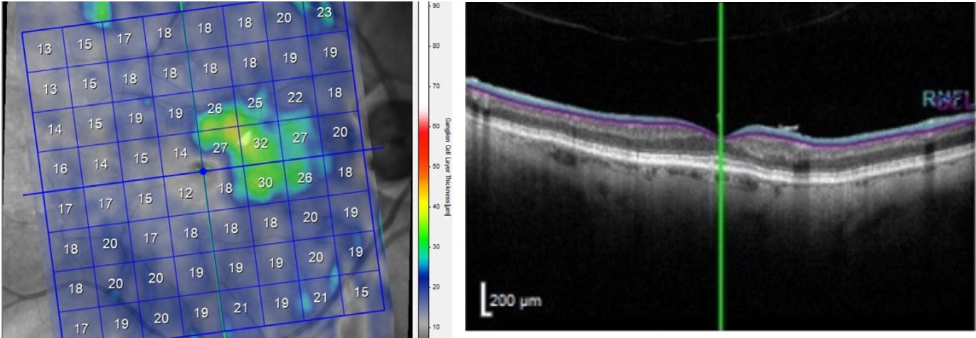 Significant macular ganglion cell layer loss OD, except for the ganglion cells in the PMB.