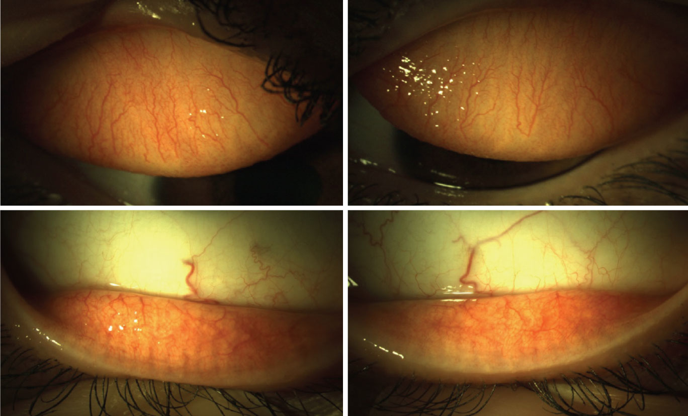 Eversion of the upper and lower eyelids reveals mild papillae of the palpebral conjunctiva in each eye.