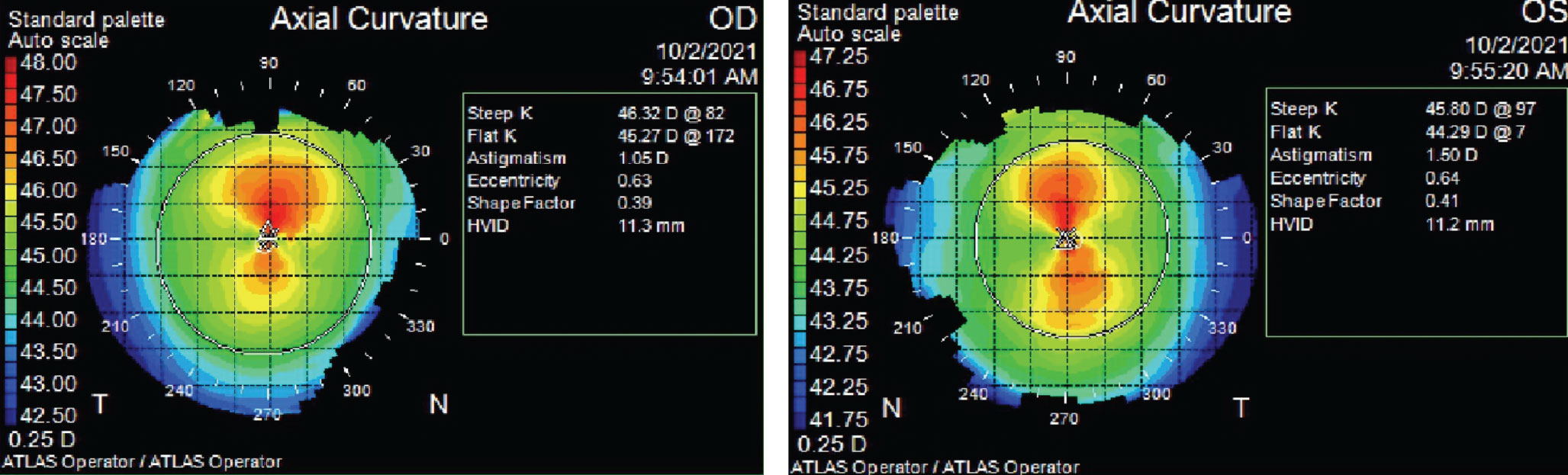 Zeiss Atlas axial topography maps of both eyes show smaller-than-average HVID measurements and steeper-than-average K readings.