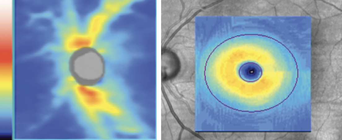 Researchers created an algorithm that may help diagnose glaucoma purely from retinal thickness-related values.