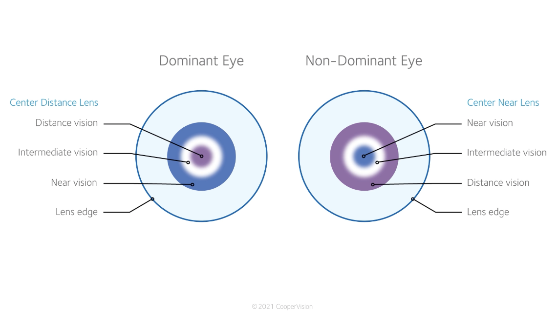 This image shows the multiple vision correction zones featured in some of CooperVision’s multifocal and multifocal toric lenses, aiming to provide patients with clearer near, intermediate and distance vision.