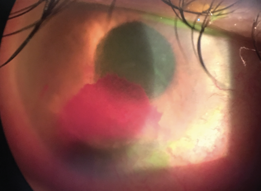 This was the patient’s presentation on slit lamp exam. She reported blurry vision as well.