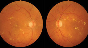 Hyperreflective foci may indicate macular edema progression and help guide treatment in affected patients.