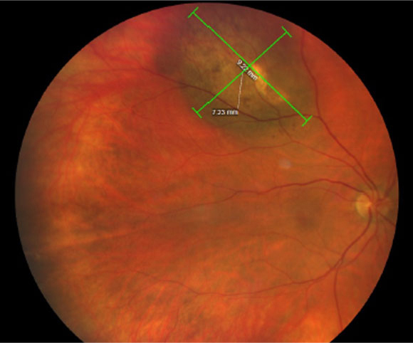 Beware the differences in OCT findings between small, medium and large tumor sizes in choroidal melanoma patients or suspects.