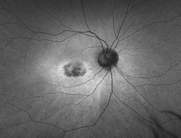 Plaquenil-induced retinopathy causes several retinal parameters to alter.