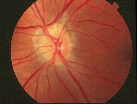 IOP reduction may be an effective way to treat progressive optic neuropathy and ocular hypertension.