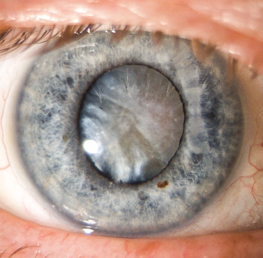Skilled cataract surgeons were shown to have lower complication rates in uveitic eyes than novices, the study also found.