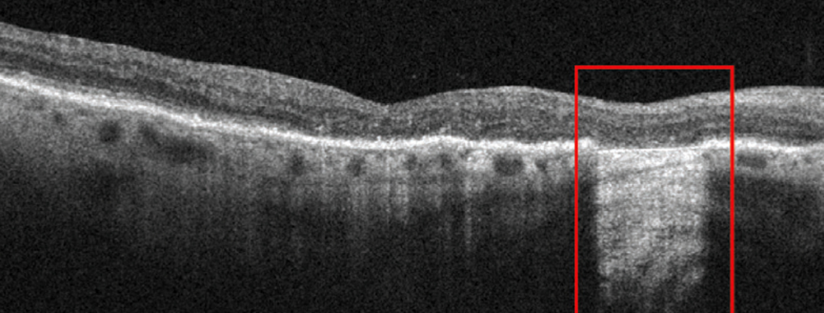 Greater attention to evidence of incomplete or complete (shown) RPE and outer retinal atrophy better identifies the status of GA patients.