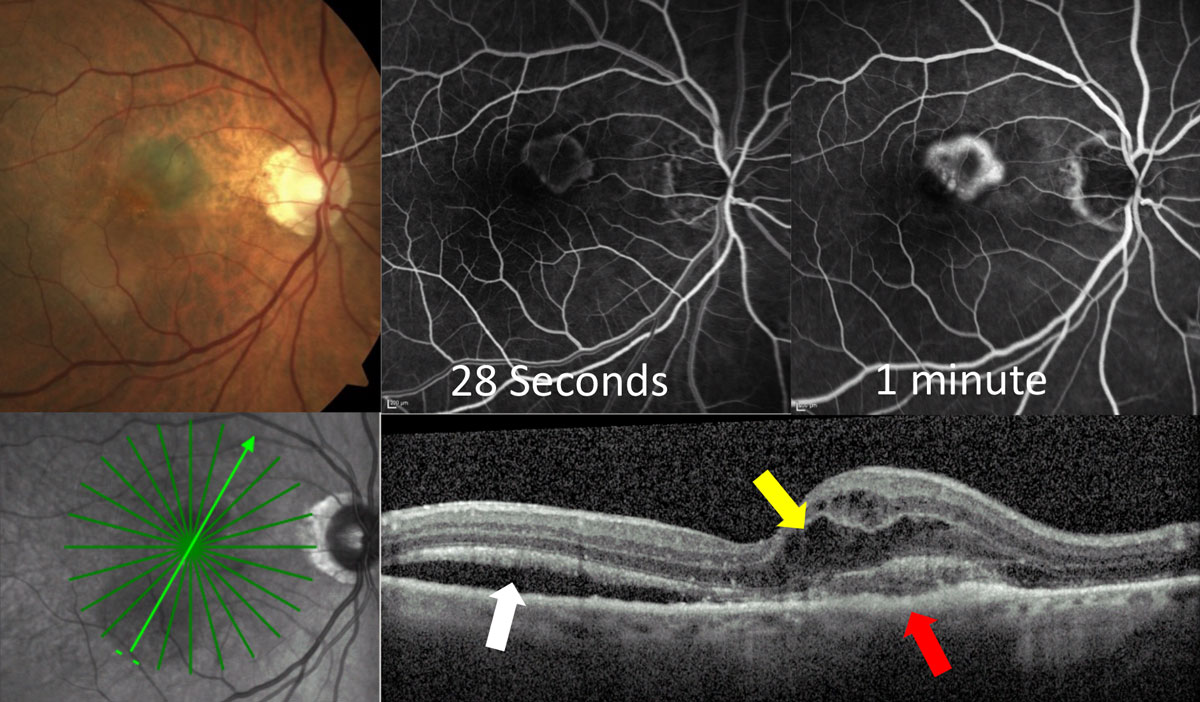 Intraretinal fluid (yellow arrow) may help predict visual acuity in nAMD.