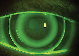 A smaller back optic zone diameter was able to improve myopia control efficacy within one year.