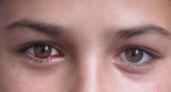 Malignancy may be indicated by bloody tears and, if caught early, can increase a patient’s life expectancy.