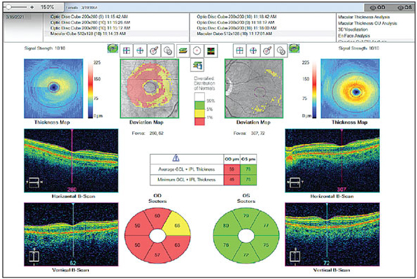 Certain structural parameters may aid in identifying glaucoma patients at higher risk of negative side effects.