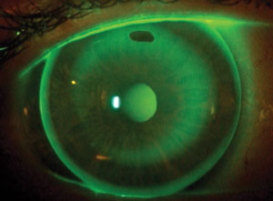  Ocular side effects of ortho-K wear tend to resolve within a year.