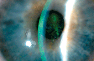 MMP concentration may dictate effective treatment strategies in corneal erosion patients.