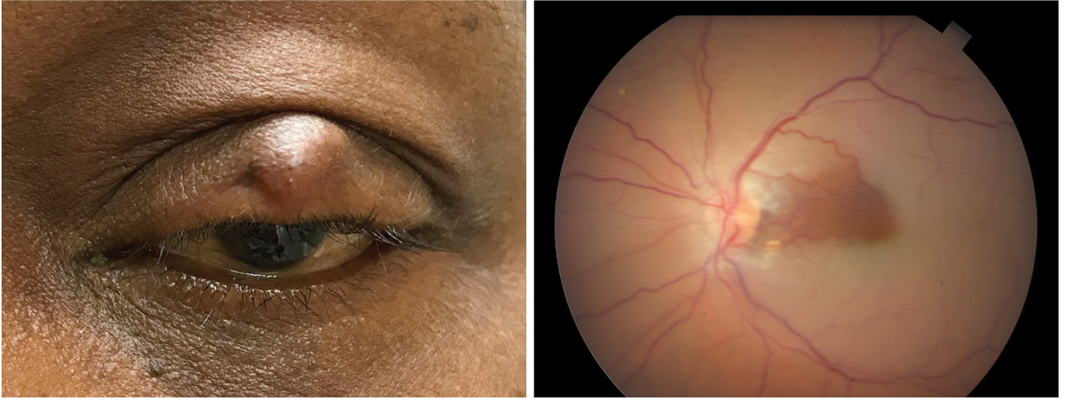 A chalazion (at left) that is easily observable via a video consult is amenable to optometric consult using telemedicine services. By contrast, a central retinal artery occlusion with cilioretinal sparing (at right) is one example of a condition where the presumable complaint of vision loss would necessitate an in-office visit for treatment and diagnosis. 