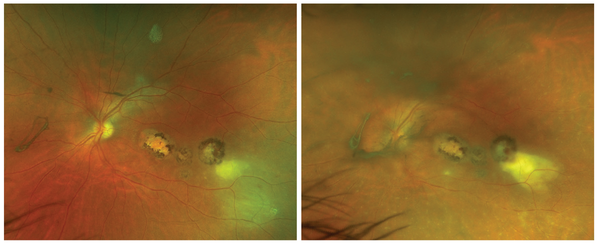 Figs. 1 and 2. Ultra-widefield photo of the left eye on presentation and on follow-up four days later.