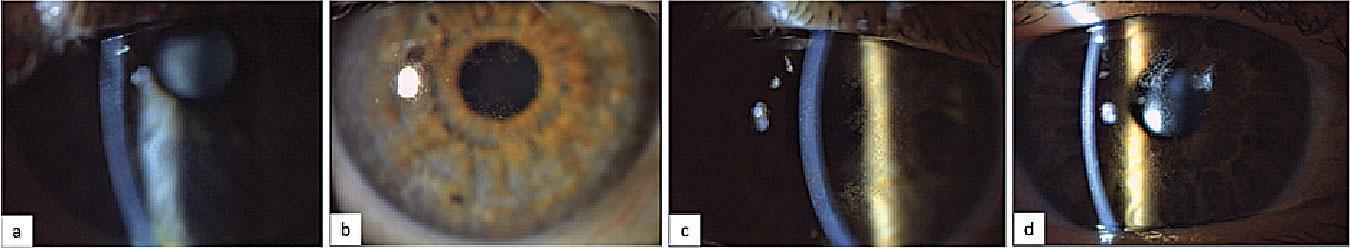 Slit lamp images of patients with mild (a), moderate (b) and severe (c, d) microcystic epithelial changes.