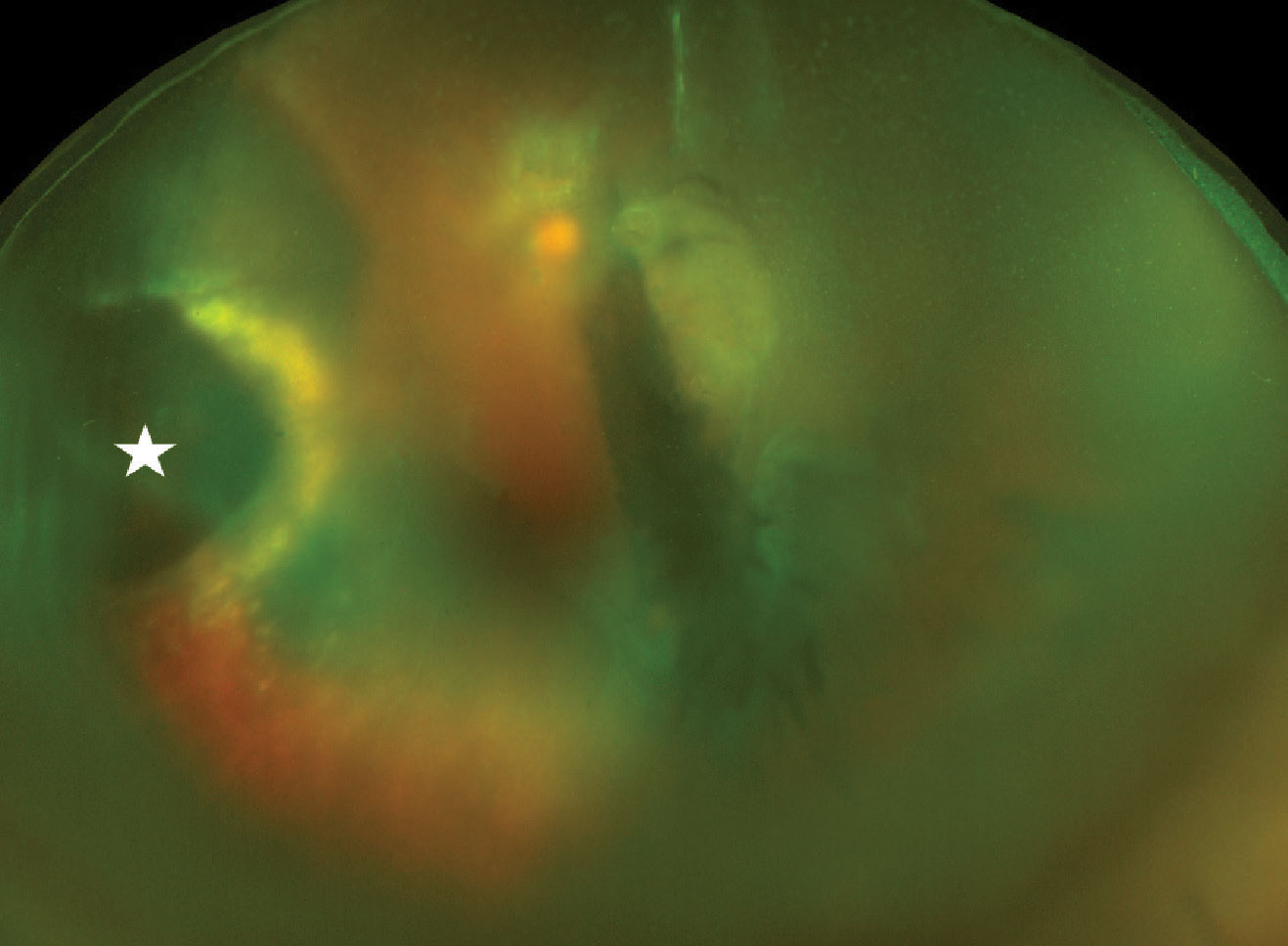 Widefield fundus photo of the left eye on presentation. There is dispersed vitreous hemorrhage blocking the view partially, but a multilayered hemorrhagic lesion (white star) on the left side of the image can be visualized. There is surrounding exudation seen as a yellowish glow.