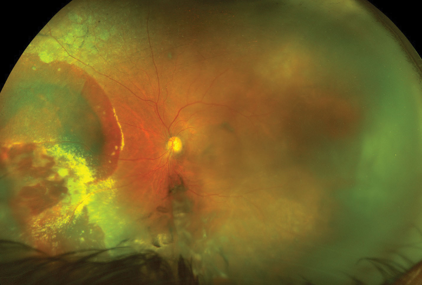 The left eye at the one-month follow-up after a single anti-VEGF intravitreal injection. The vitreous hemorrhage has cleared partially, allowing for better visualization of the nasal retina. You can still make out the extensive hemorrhaging and exudation from the lesion. The vision at this visit improved to 20/60.