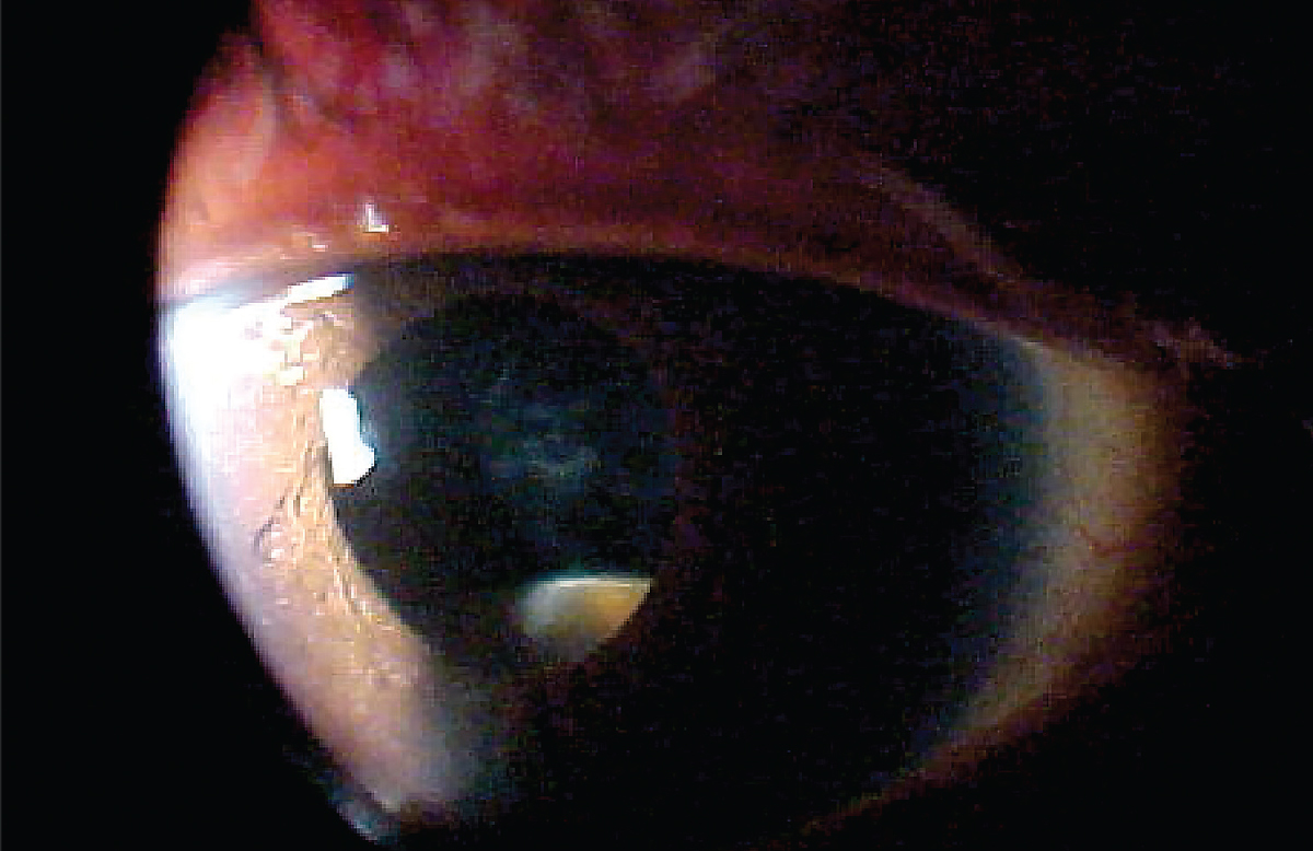This was the patient’s presentation at the slit lamp. Does this explain her symptoms?