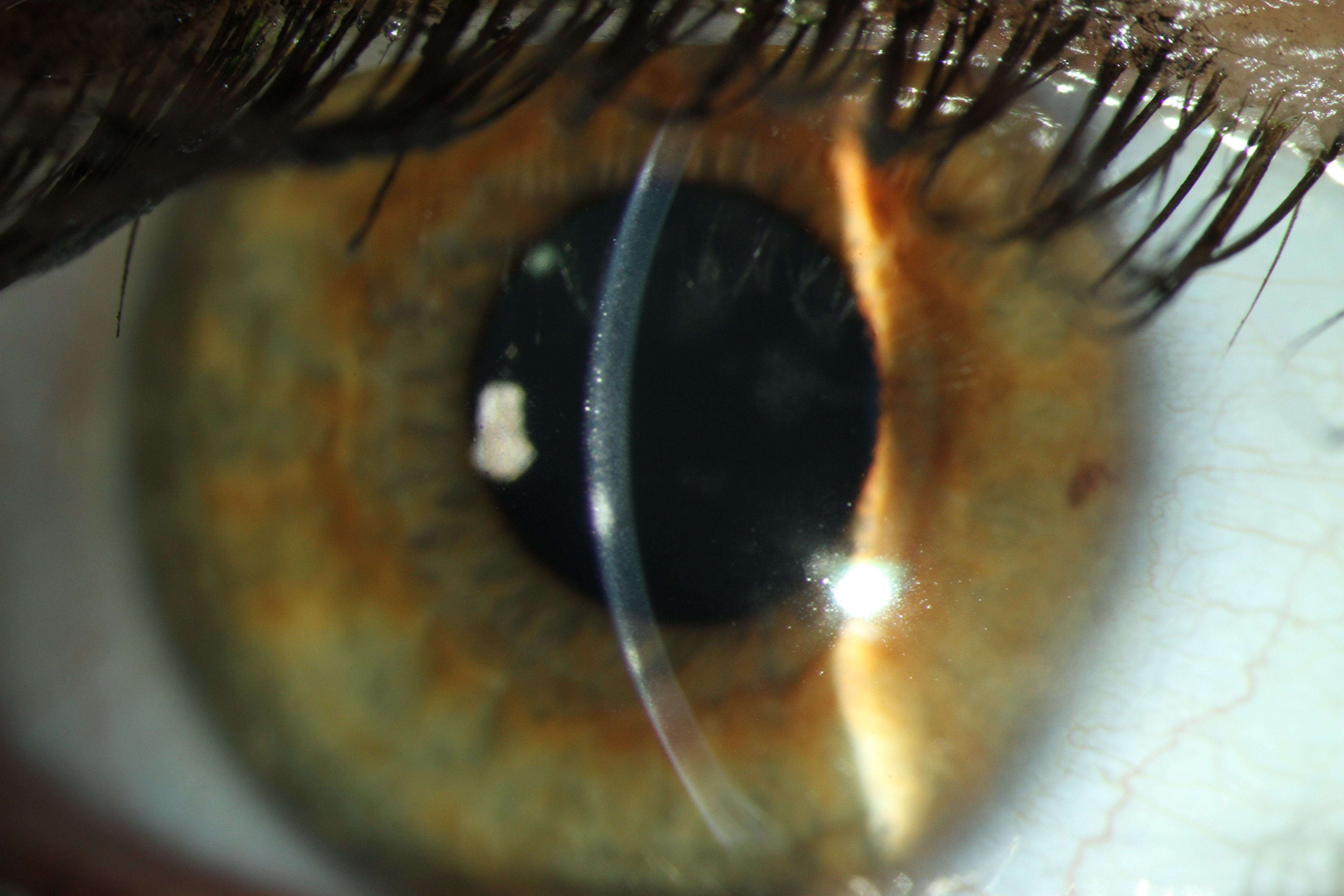 This photo shows a patient with a corneal infiltrate, another condition that would not be treatable via telehealth.