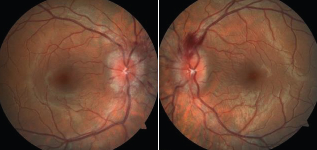 “Papilledema” is commonly used erroneously to describe other visual occurrences.