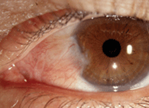 Pterygium removal by a corneal specialist or high-volume surgeon may reduce the odds of recurrence; the only problem remains potential barriers to these providers.