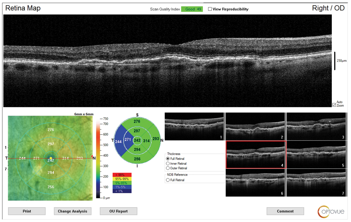 Look for the double-layer sign when monitoring AMD patients with intermediate disease.